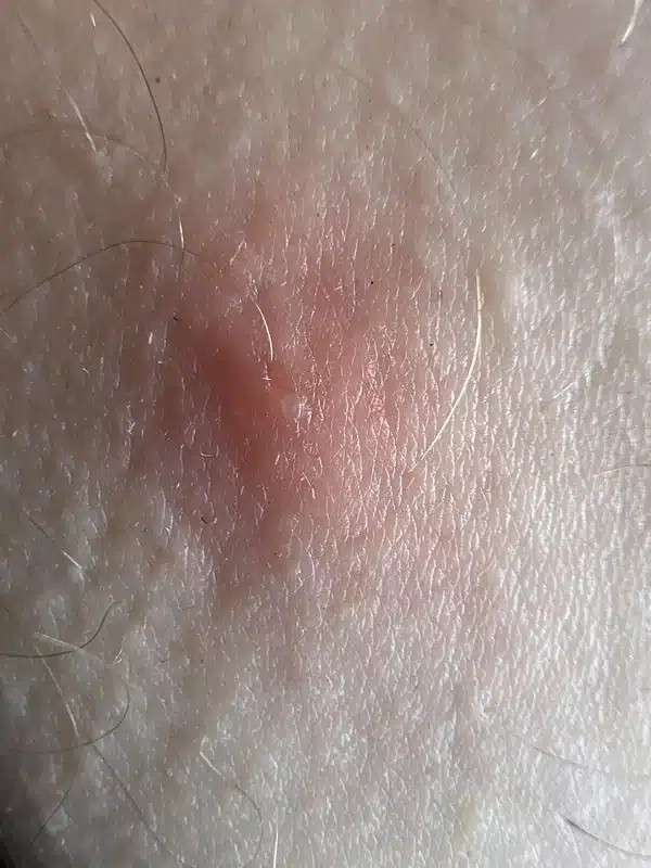 Close-up of irritated skin from chigger bite reaction