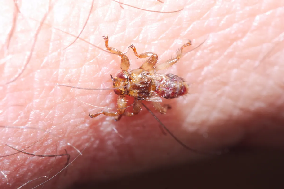 Deer ked clinging to human skin and hair showing how it grips onto hosts