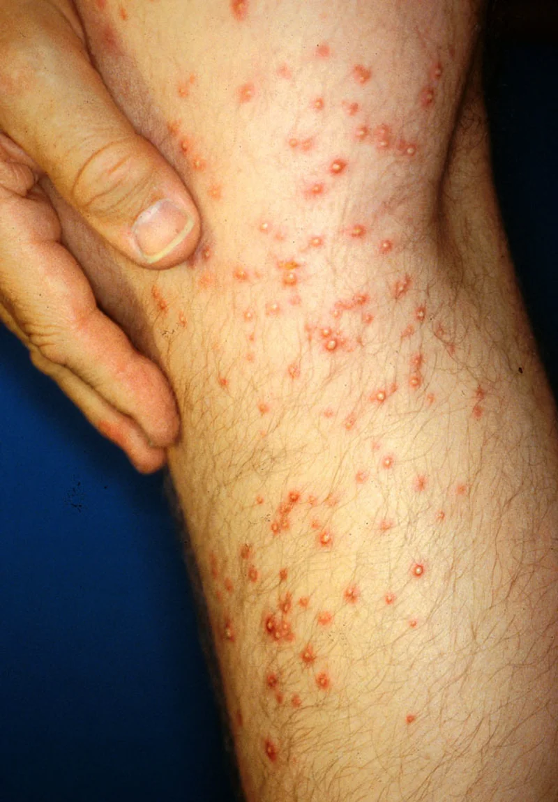 Multiple fire ant stings on human skin showing characteristic pustules