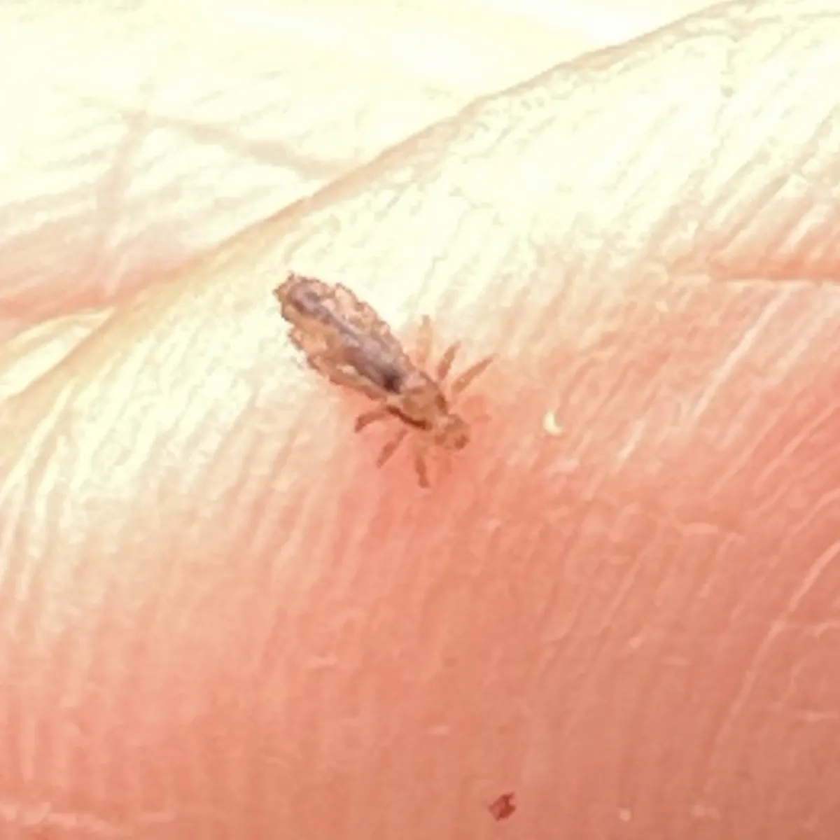 Adult head louse on a fingertip showing its small size relative to human skin